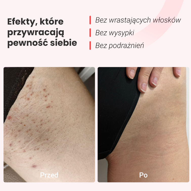 Depilator Hilda IPL